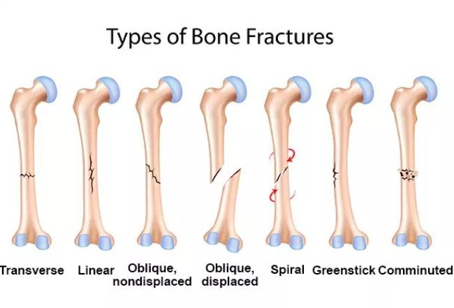 骨折的原因