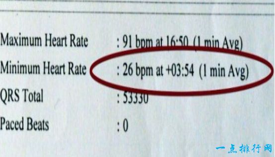 世界上心跳最慢的人，英国老人的心跳速率每分钟26下（平均两秒一次）