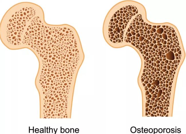 骨质疏松症